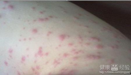 皮肤过敏吃茭瓜行吗