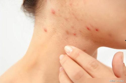 皮肤过敏吃茭瓜行吗